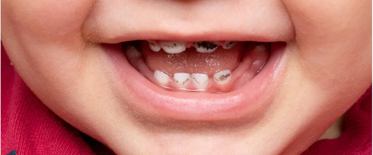 Black stain: Everything you need to know about harmless tooth discolouration