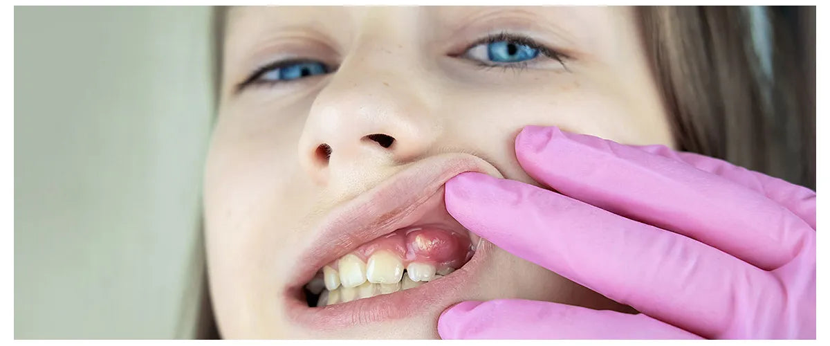 Oral abscess: Why it needs to be taken seriously