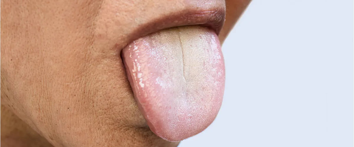 Oral leukoplakia: why it can be dangerous