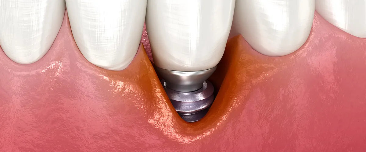 Peri-implantitis: What to do about inflammation around an implant?