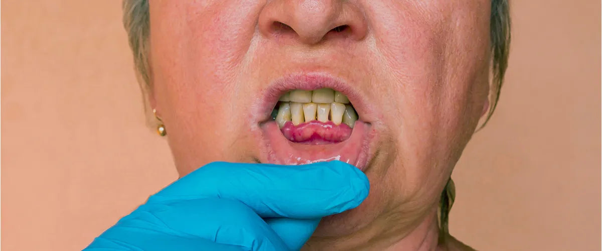 Periodontitis: Symptoms, causes and the correct treatment