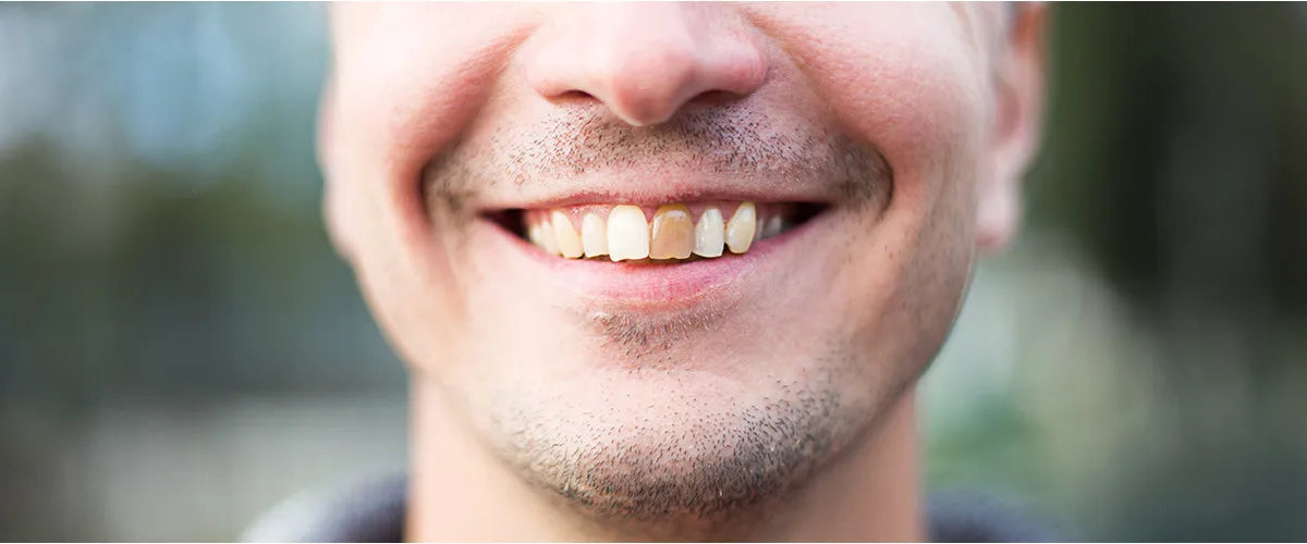 Prevent tooth erosion: How to protect your enamel