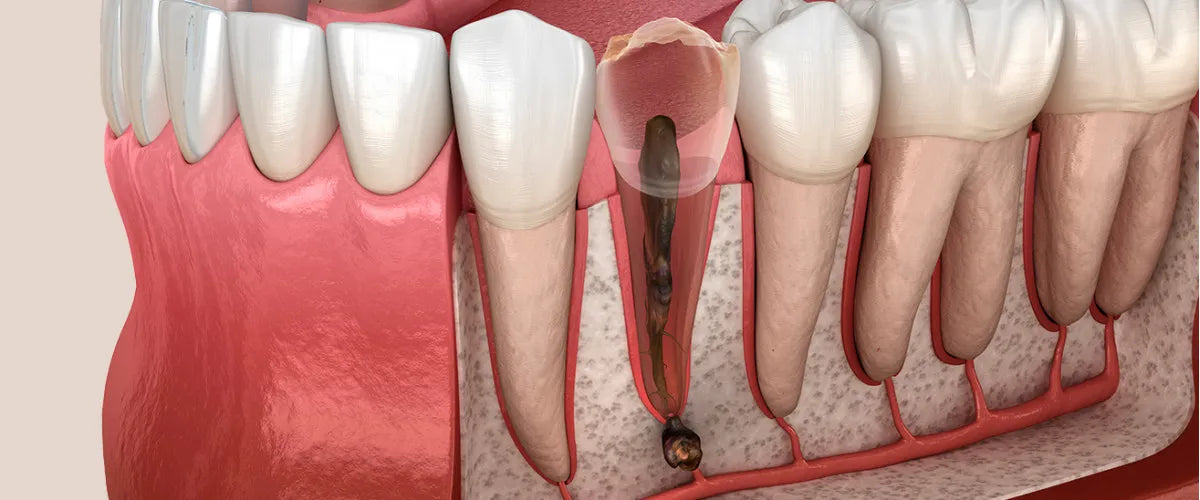 Tooth root inflammation: All about the symptoms and treatment of pulpitis