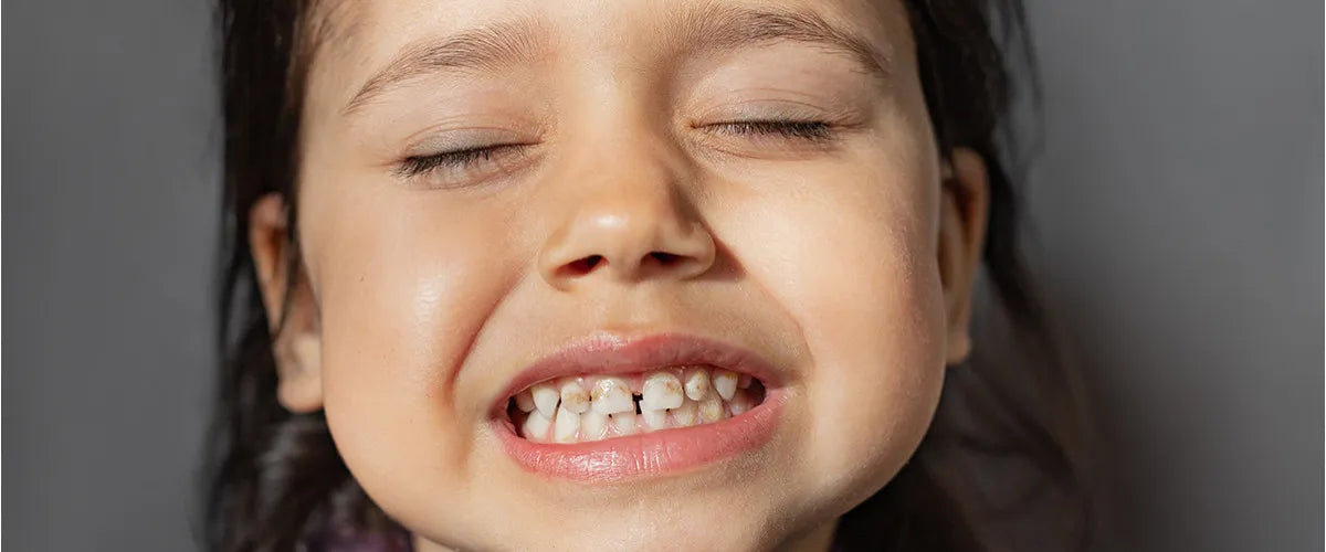 What are chalky teeth and what can you do about them?