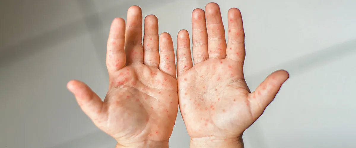 What is hand, foot and mouth disease and what can you do to prevent it?