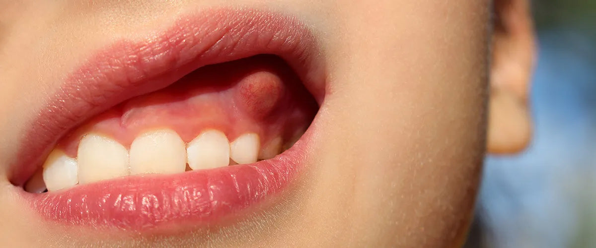 How to combat dental fistulas?