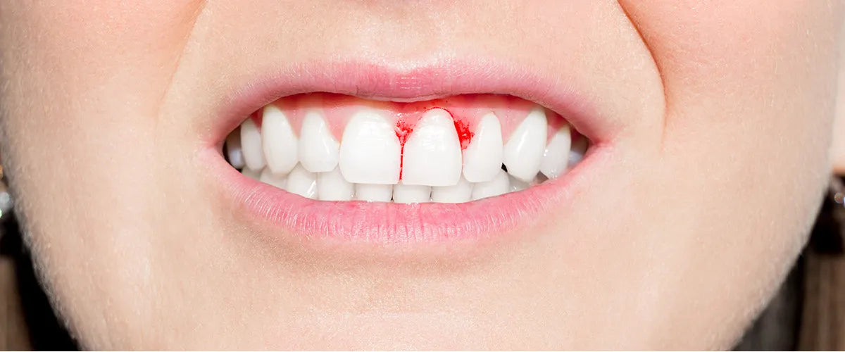 How to combat bleeding gums