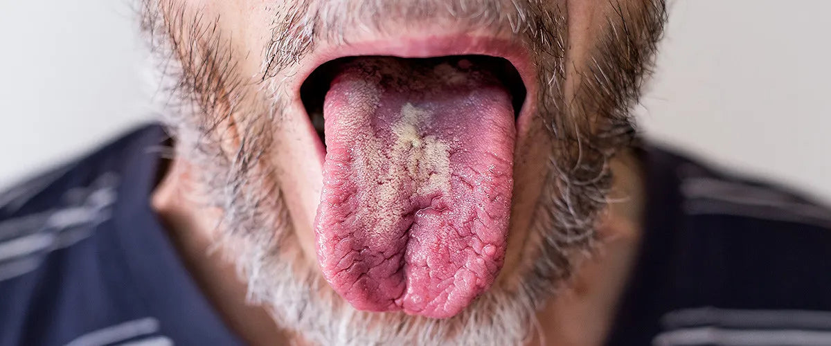 Oral thrush: Everything you need to know about the fungal infection of the mouth