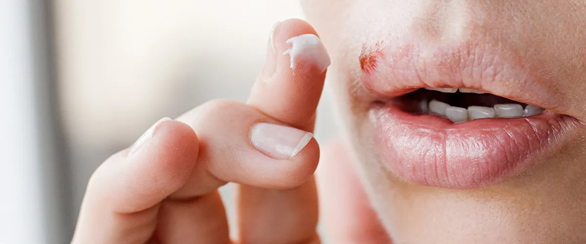 What are cold sores and what can you do about them?